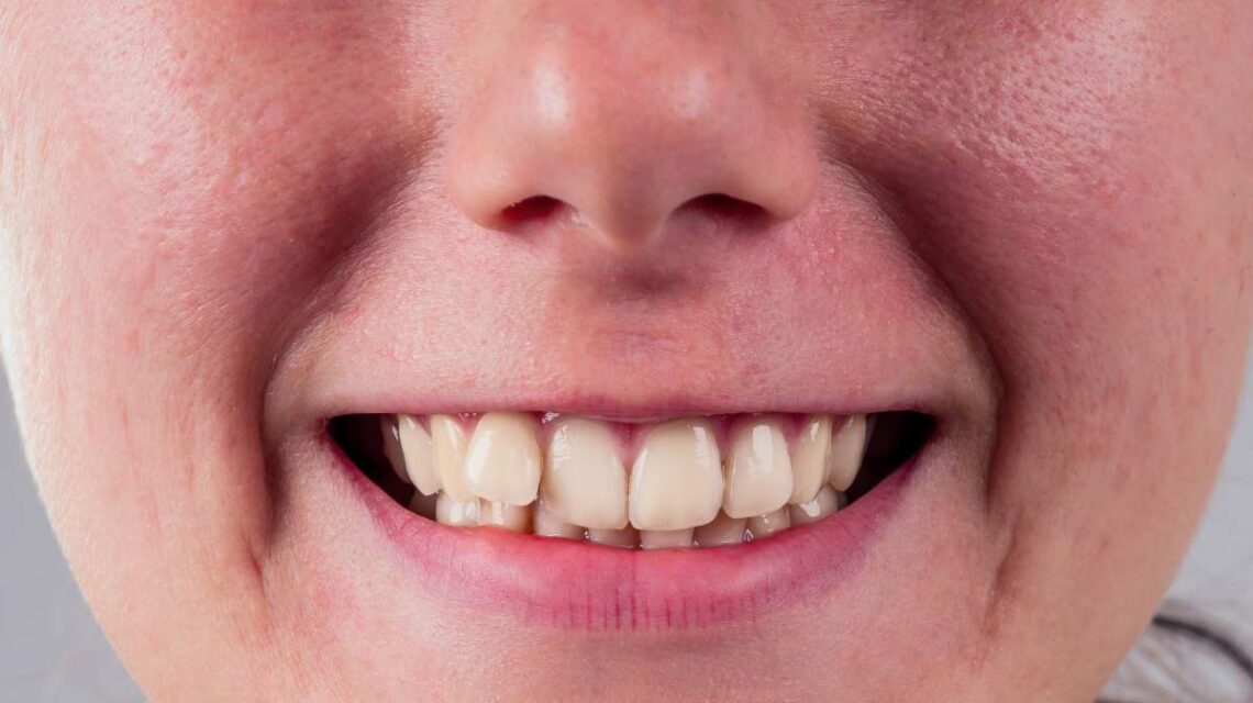 white smile with curvature tooth of young woman on whitw background in studio .treatment braces system in the office of the orthodontist.