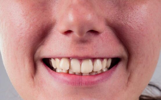 white smile with curvature tooth of young woman on whitw background in studio .treatment braces system in the office of the orthodontist.